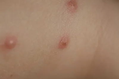 Piqûre de punaise de lit