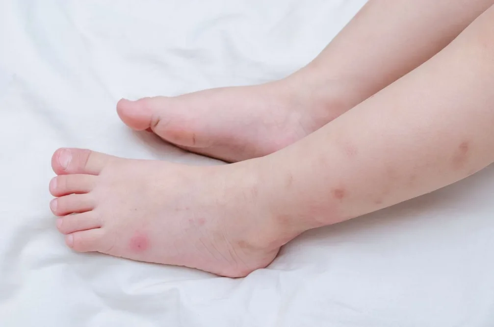 Piqûres de punaise de lit sur un enfant