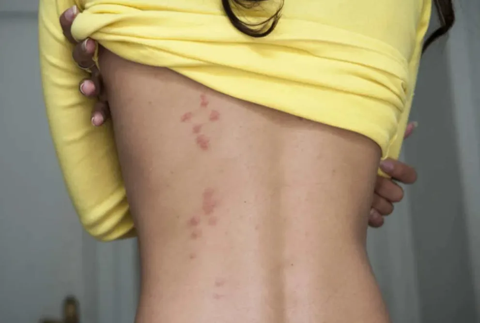 Quels sont les symptômes d'une allergie punaise de lit ?