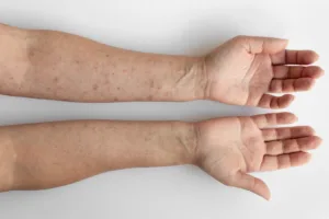 Allergie Acarien 2 piqure d'acarien sur les avant bras