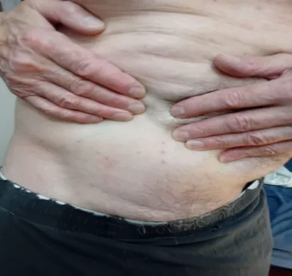 Homme montrant son abdomen avec des traces de piqûres de punaises de lit.