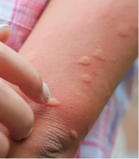 Personne grattant des piqûres rouges et gonflées sur son bras, signes d'irritation ou de piqûres d'insectes.