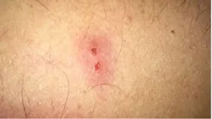 Capture decran 2024 11 15 093331 morsure d'araignée