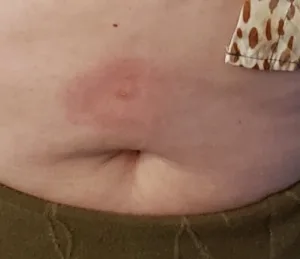 bed bug bite above my piqure d'acarien sur le ventre