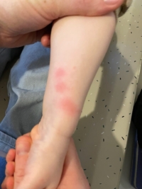 Rougeurs sur le bras d’un enfant causées par des piqûres de punaises de lit.