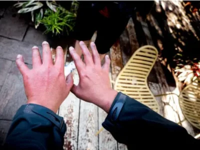 Réaction cutanée importante aux piqûres de punaises de lit