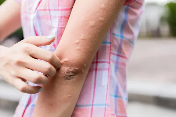 piqûres de moustiques sur le bras Bras avec de nombreuses boursouflures rouges, résultat probable de piqûres de moustiques.