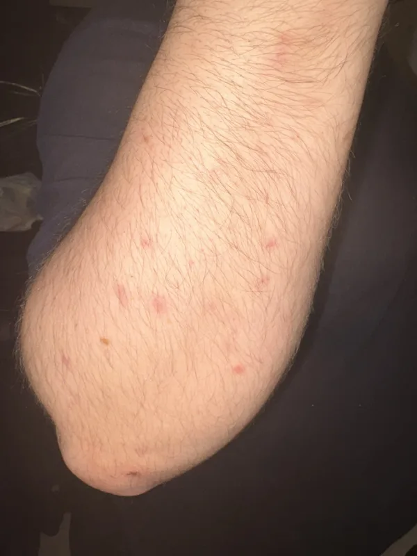 Multiples piqûres de punaises de lit sur un bras : symptômes courants chez les victimes Bras masculin avec plusieurs traces de piqûres rouges causées par des punaises de lit