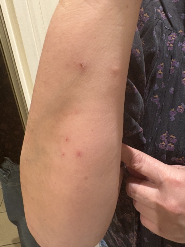 Bras d’une personne montrant plusieurs piqûres rouges caractéristiques des punaises de lit