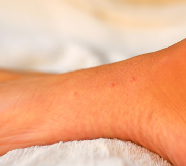 Boutons de punaise de lit sur le pied.