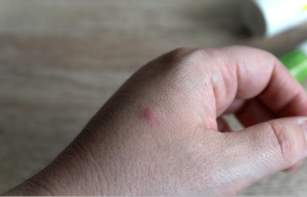 Piqûre isolée sur la main causée par un moustique