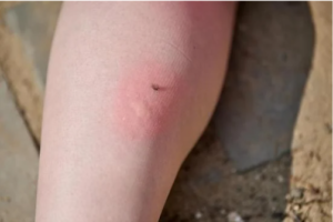 bouton de moustique sur un bras.