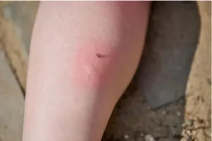 bouton de moustique sur un bras.