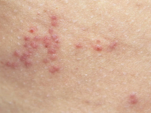 bouton regroupé punaise de lit réaction d'un individu